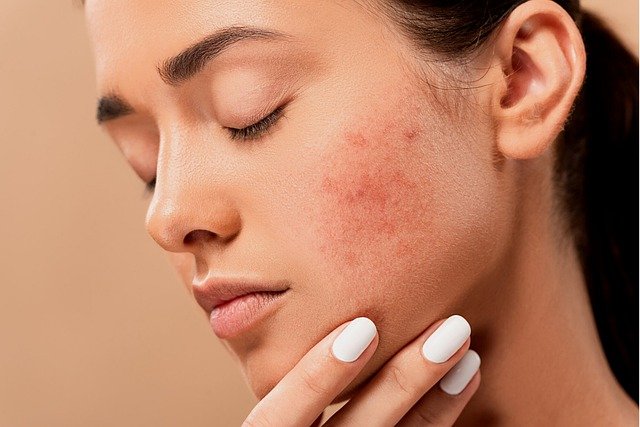 Try This Top-Rated $35 Acne Treatment Gel for FREE
